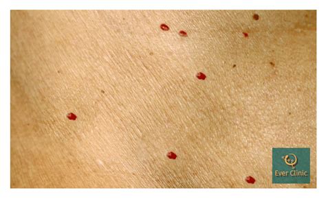 Cherry Angioma Removal Glasgow Laser Removal Skin Clinic