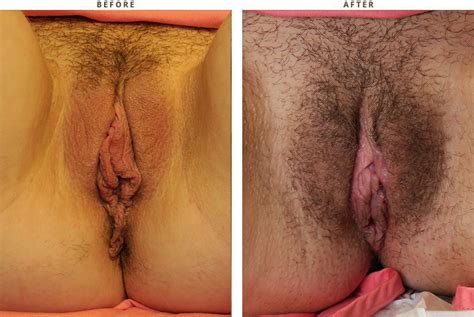 Labiaplasty Before After Pictures Dr Turowski Plastic Surgery