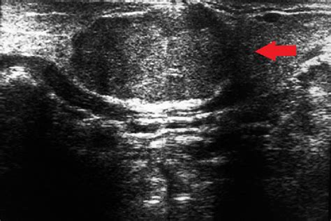 Ultrasound Shows 284×201 Cm Well Defined Predominantly Hypoechoic