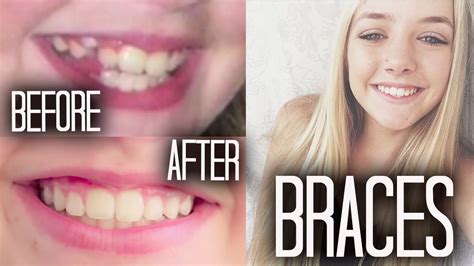Braces 101 Before And After Youtube