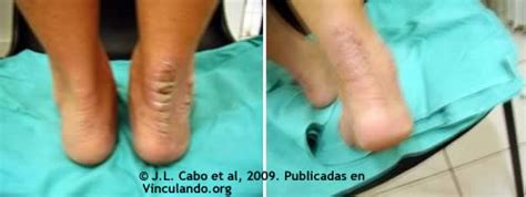 The Therapeutic Action Of Dermune Cream On Dermatitis Lichen Planus
