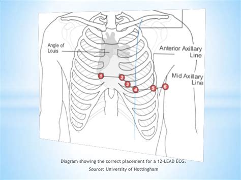 Picture Of 12 Lead Ecg Placement Rc Nachtflug Photos