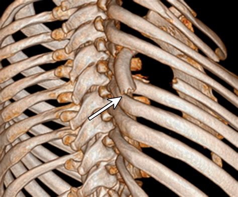 Traumatic Rib Injury Patterns Imaging Pitfalls Complications And Treatment Radiographics