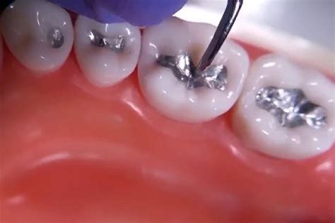 From the historical debate about the use of dental amalgam fillings. What Is Amalgam? - Holistic Dentist Phoenix | Phoenix ...