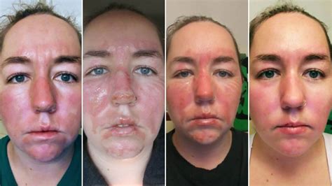 Woman Shares 2nd Degree Facial Burn Healing Process Before And After Photos Allure