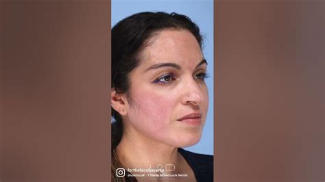 Rhinoplasty Done By Bay Areas Top Facial Plastic Surgeons Drs Lieberman And Parikh Youtube