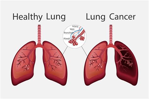healthy and unhealthy human lungs normal lung versus lung cancer human organ icon vector