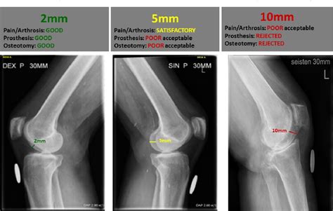 Radiographic Optimization Of The Lateral Position Of The 53 Off