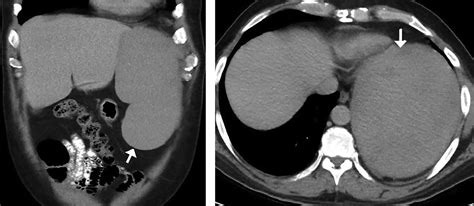 Atraumatic Splenic Rupture In Acute Myeloid Leukemia Cleveland Clinic