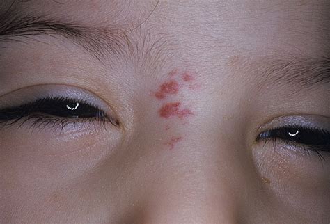 Capillary Hemangiomas In Infants Pictures 9 Photos And Images