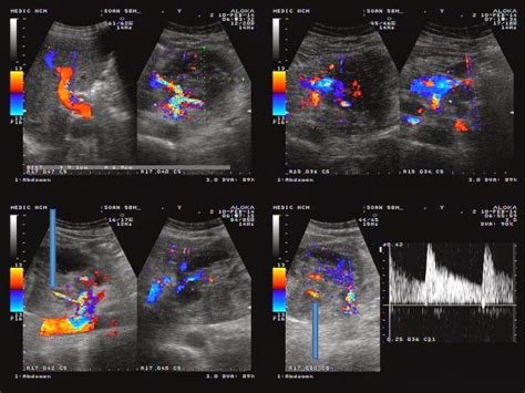 The procedure allows you to quickly inspection and palpation of such a high result does not give, but because examination of lymph nodes the uniqueness of the ultrasound of the lymph nodes in the neck is that almost no. VIETNAMESE MEDIC ULTRASOUND: February 2014