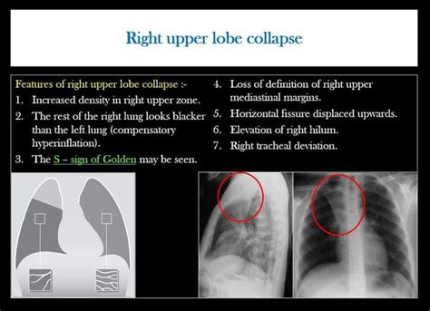Pin By Islam Abuishqair On Radiology Collapse Radiology Definitions