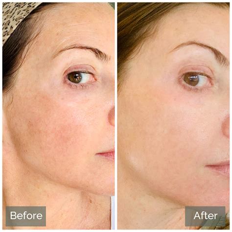 Medical Grade Skin Peels From Within Medical