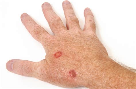 Skin Cancer Lesions On Hands