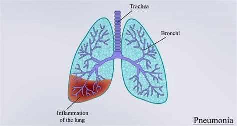 List Of Most Common Lungs Diseases In The World Human Body Organs