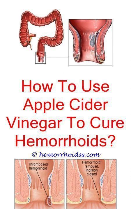 How To Do A Colon Cleanse Cure For Hemorrhoids Bleeding Hemorrhoids