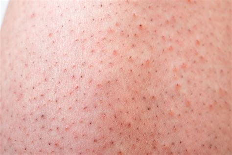 Vancouver Cherry Angioma Removal Red Spots Removal In Surrey
