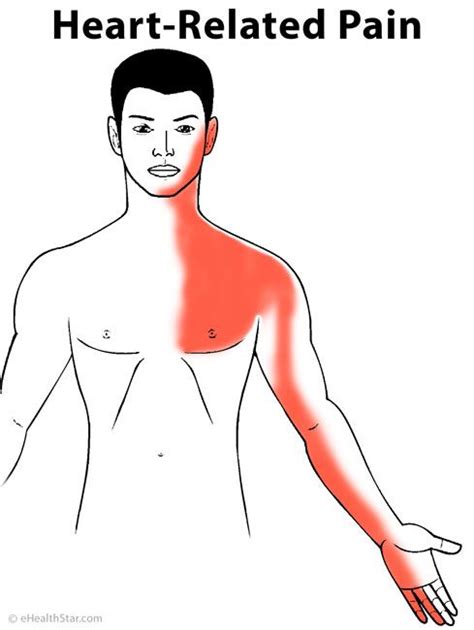 Arm Pain In Angina Pectoris Or Heart Attack Other Causes Of Arm Pain