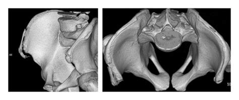 3d Ct Scan Avulsion Of A Part Of The Iliac Crest Apophysis And The