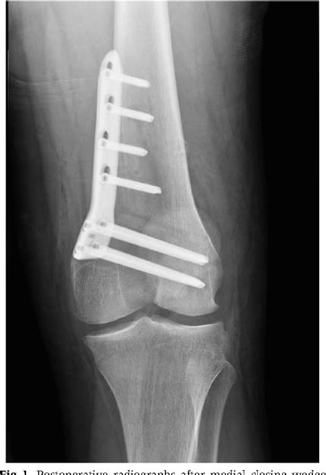 Table 4 From Distal Femoral Osteotomy For The Valgus Knee Medial