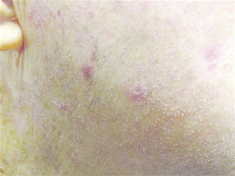 Multiple Pink Papules And Sun Damaged Skin Of The Right Cheek