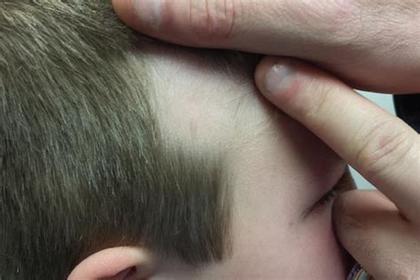 Boy Has Had “bald Spot” Since Birth Clinician Reviews