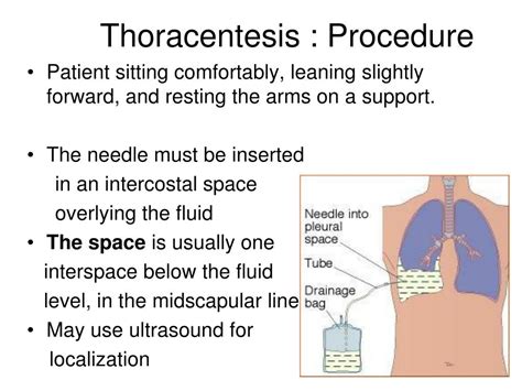 Thoracentesis Procedure Steps