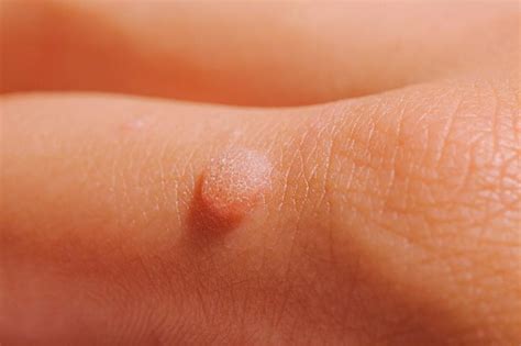 Is There A Medical Treatment For My Warts Northstar Dermatology Dermatology