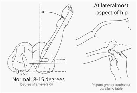 Femoral Anteversion Test Craigs Test Epomedicine