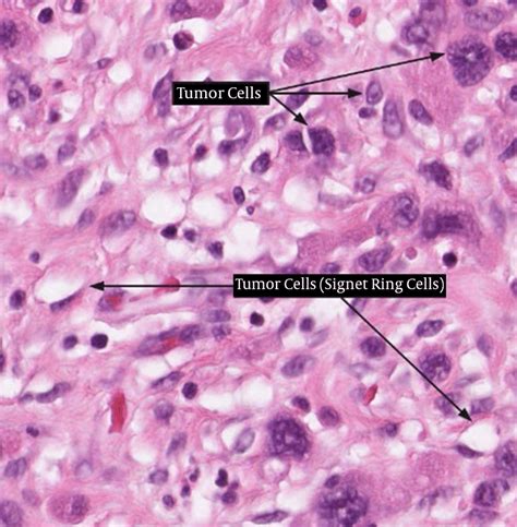 Diffuse Type Gastric Carcinoma With Signet Ring Cells Download