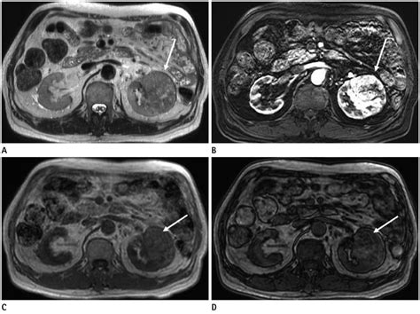 Current Mr Imaging Of Renal Cell Carcinoma