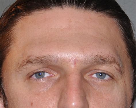 Forehead Brow Bone And Temporal Contouring Plastic Surgeon Dr