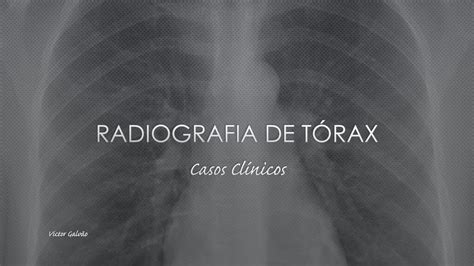 Radiografia De T Rax Casos Cl Nicos Youtube