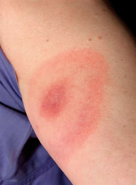 Spider Bite Treatment 6 Home Remedies To Try Thegearhunt