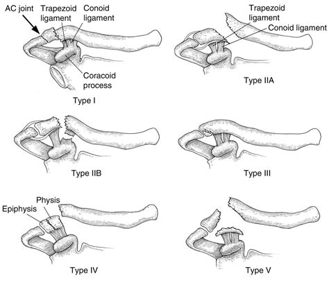 Clavicle Fractures Distal Trauma Orthobullets