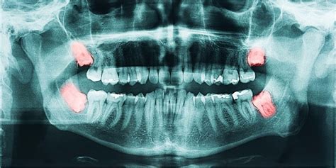Wisdom Teeth Removal Impacted Tooth Extraction The Procedure Explained