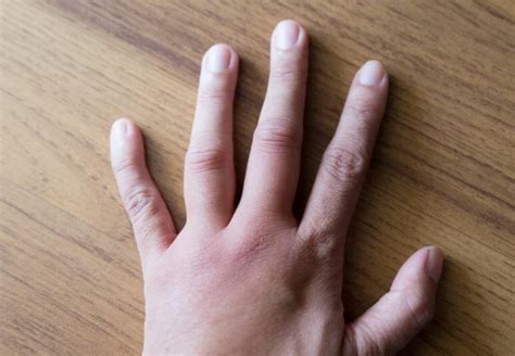 Understanding Swollen Knuckles Arthritis Causes And Treatment