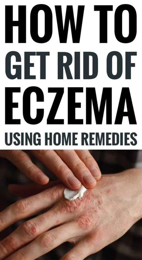 How To Get Rid Of Eczema Using Home Remedies Get Rid Of Eczema