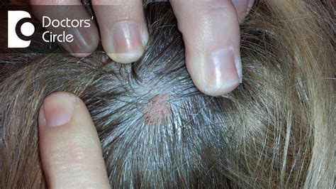 What Does Small Skin Colored Lump On The Scalp Indicate