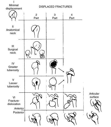 Proximal Humerus Fracture Core Em