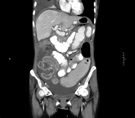 Abdominal Ct Coronal Section Distended Gallbladder With Wall Edema