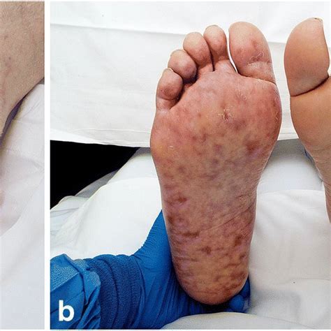 Livedo And Nonpalpable Purpura A Side Of Left Foot B Clinical