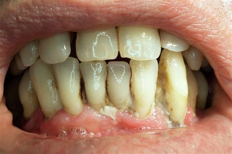 Teeth Covered With Plaque And Tartar Photograph By Dr Armen Taranyan
