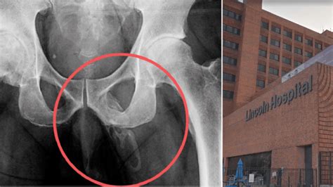Mans Penis Is Slowly Turning Into Bone Due To Rare Condition Metro News