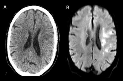 Mri provides much greater contrast between the different soft tissues of the body than computed tomography (ct) does, making it especially useful in neurological (brain), musculoskeletal, cardiovascular, and. Stroke Imaging: CT vs. MRI - Serena's Blog