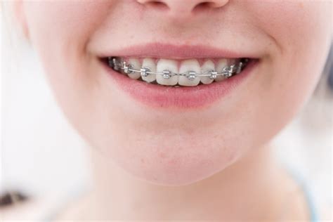 What Causes White Spots On Teeth After Braces Thomas Orthodontics