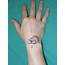 Common Hand Conditions Wrist Ganglion