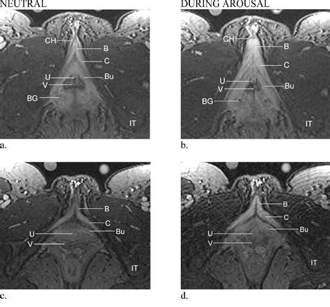MRI Of Female Genital And Pelvic Organs During Sexual Arousal