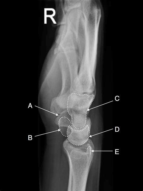 X Ray Wrist Lateral View