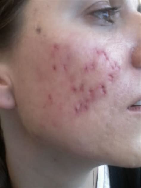 Scar Logs Cystic Acne Scar Revision Right Cheek Punch Excisions